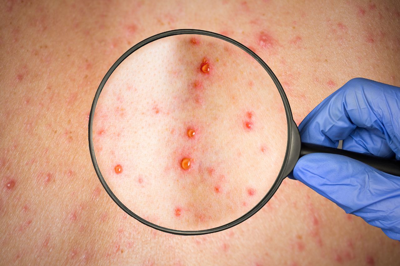 Varicela: Cómo identificar los síntomas y evitar el contagio